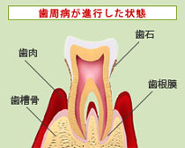 歯周病が進行した状態